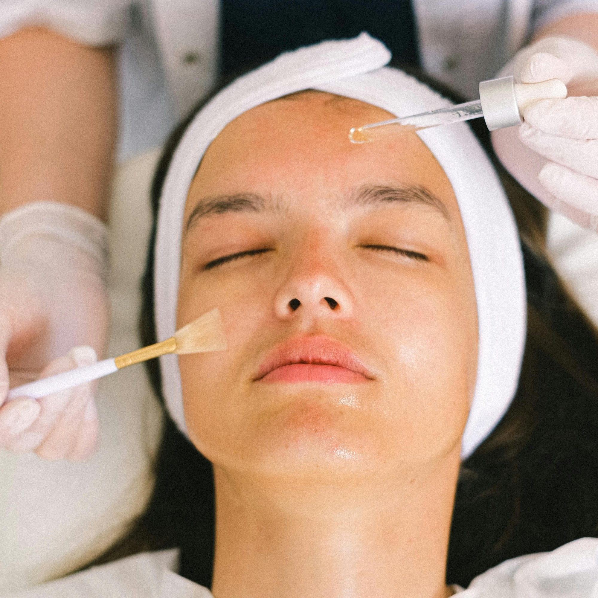 Understanding Acne Procedures: What You Need to Know