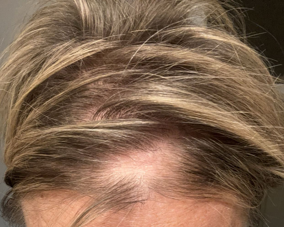 Top of the scalp with a patch of hair loss from alopecia areata, before treatment