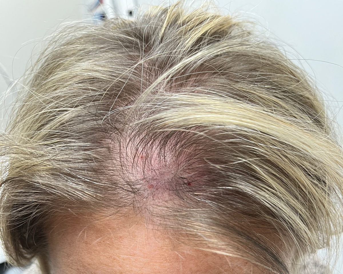 Top of the same scalp after corticosteroid injection treatment