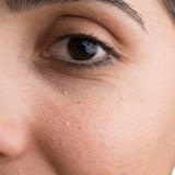 Milia Removal Consult